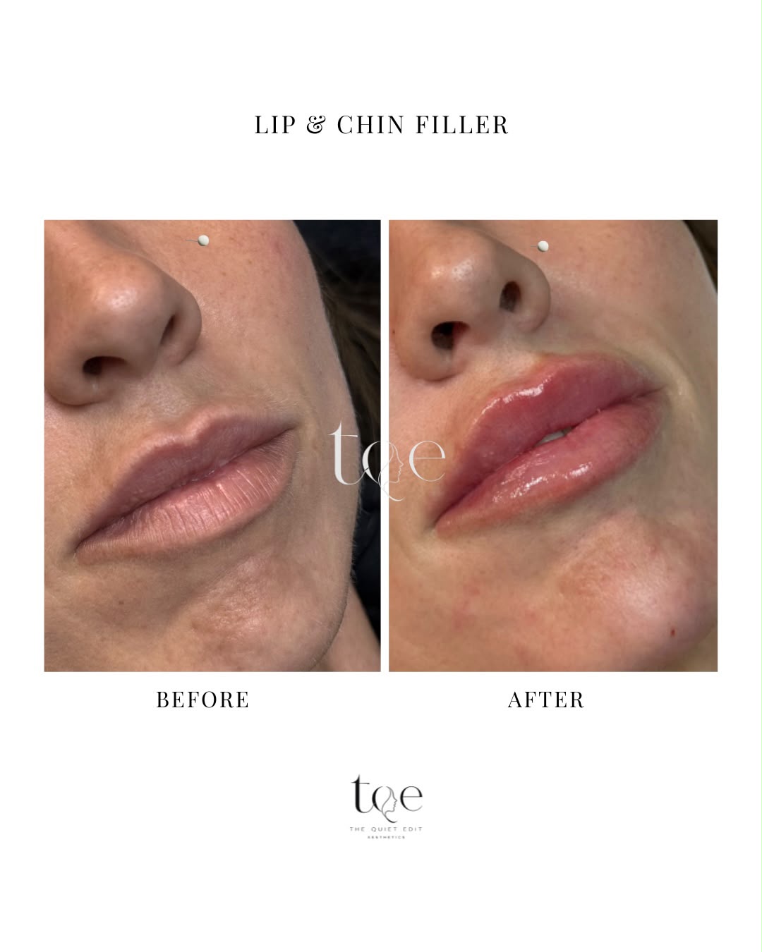 Chin & Lip Augmentation