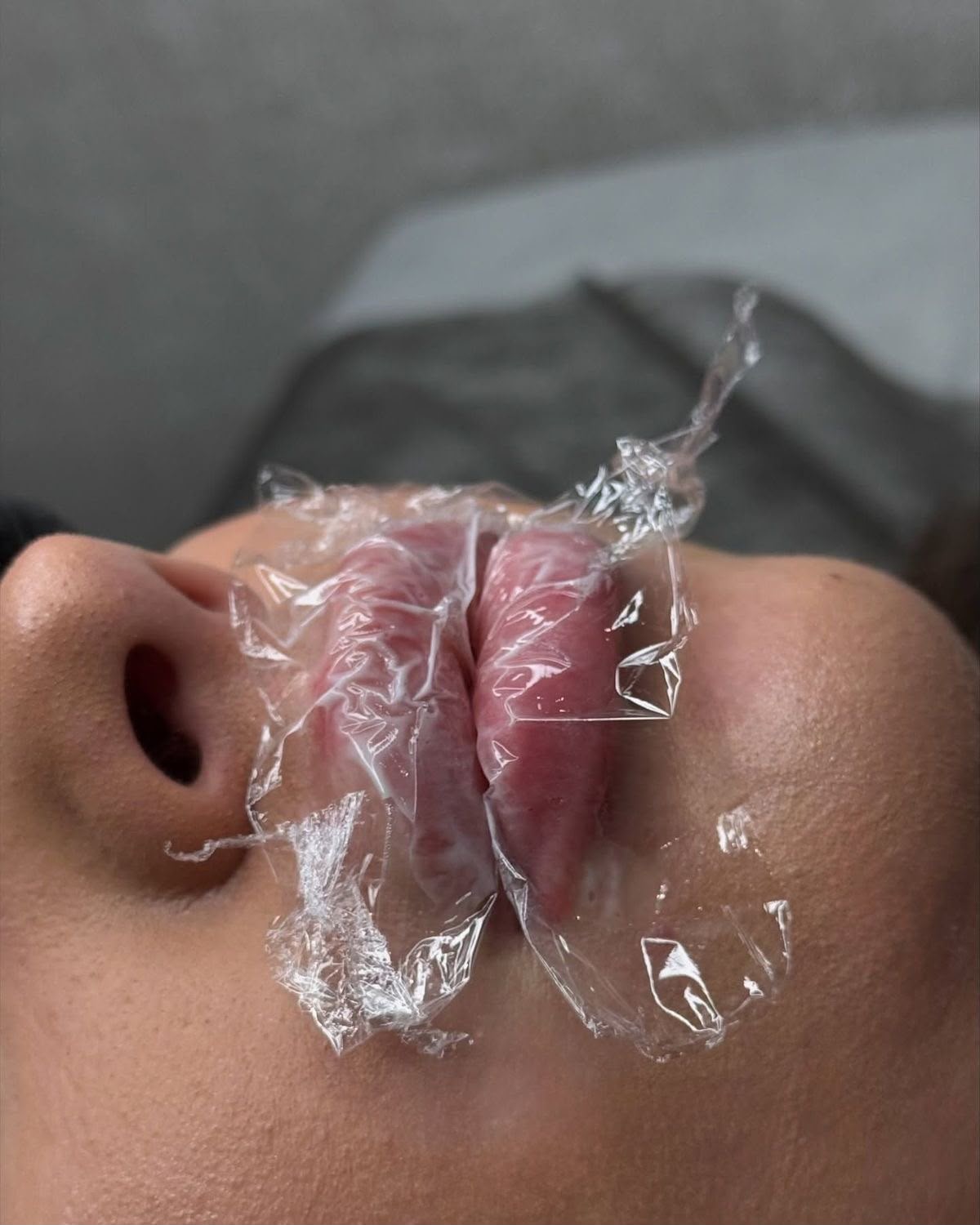 Dermal Fillers