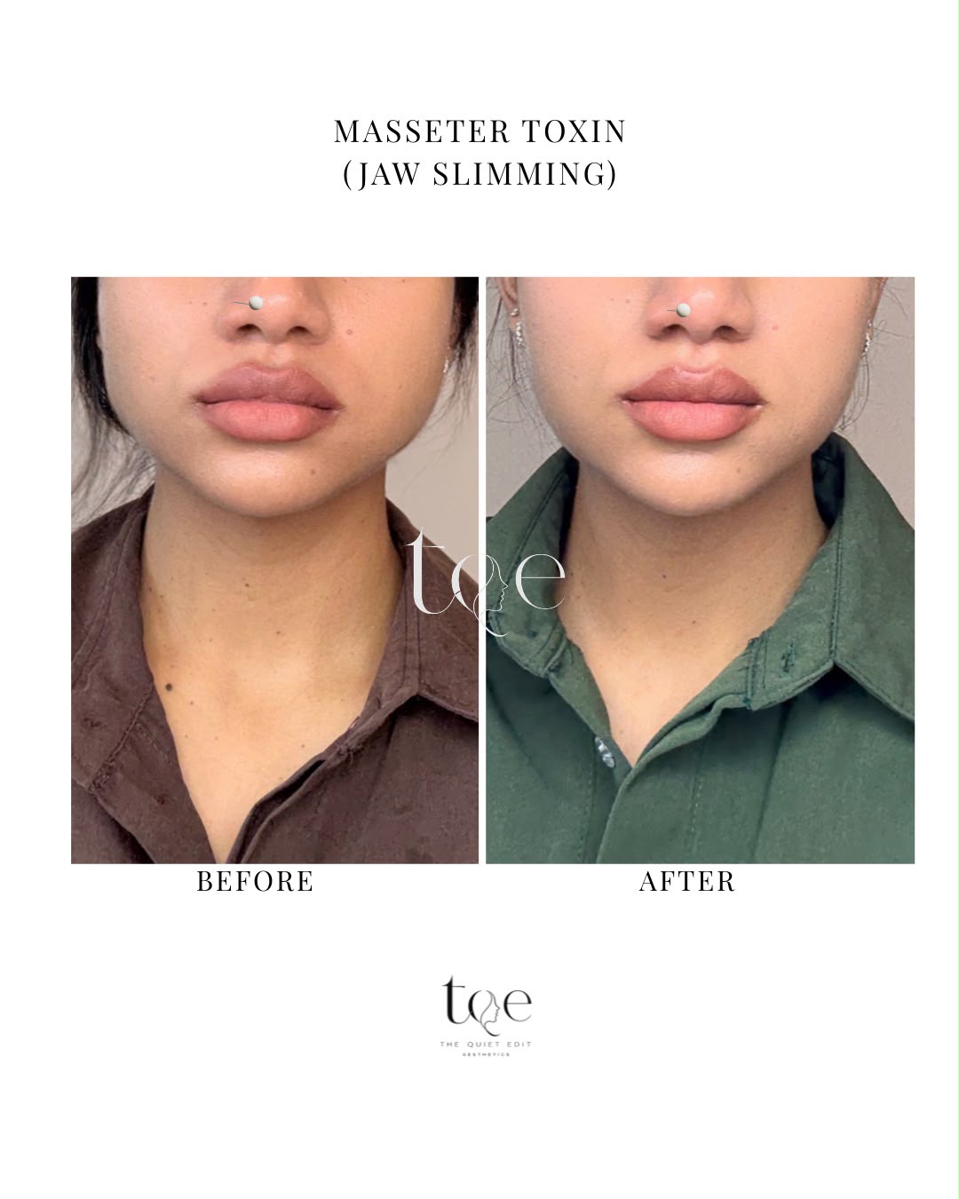 Jaw Contouring