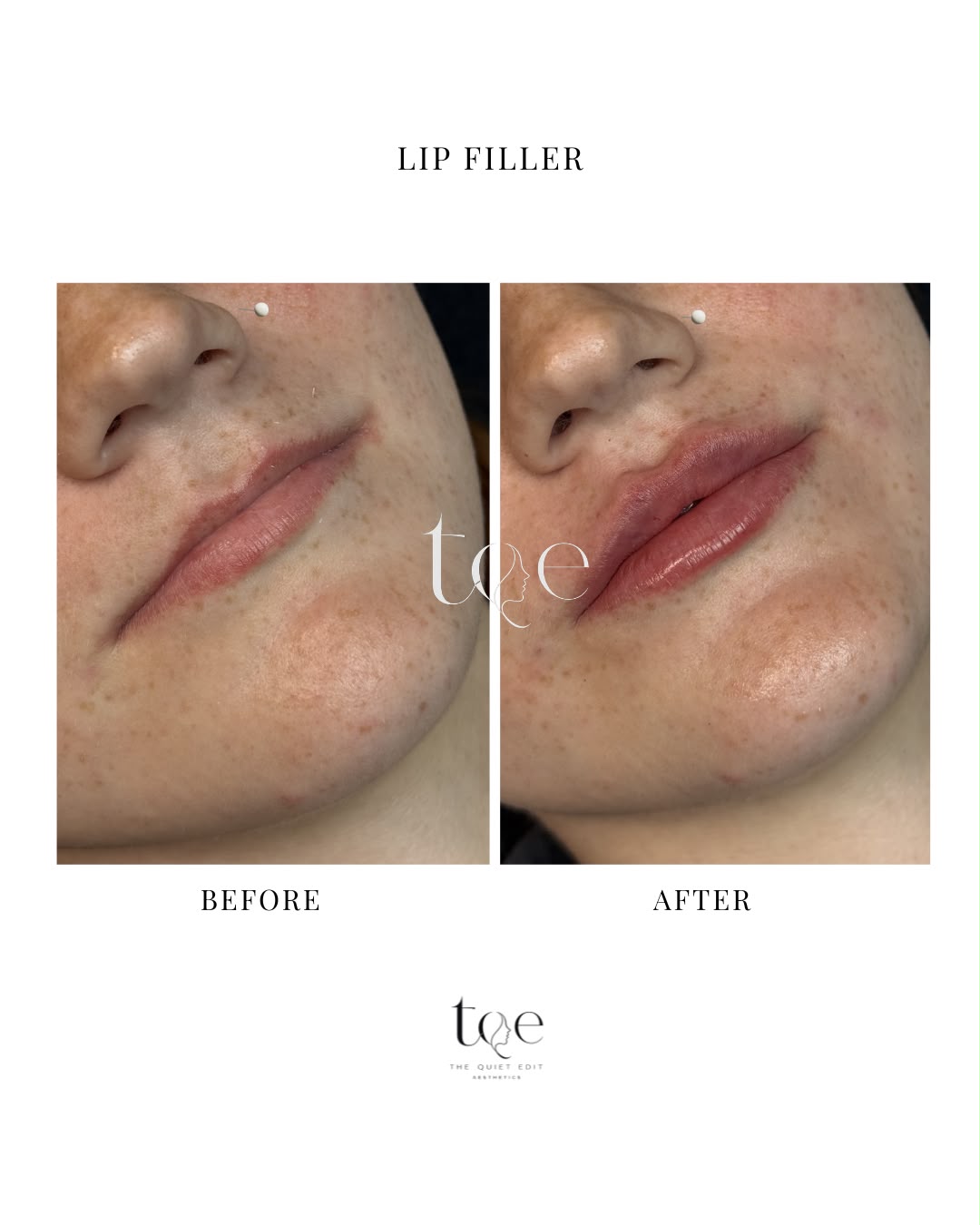 Lip Fillers