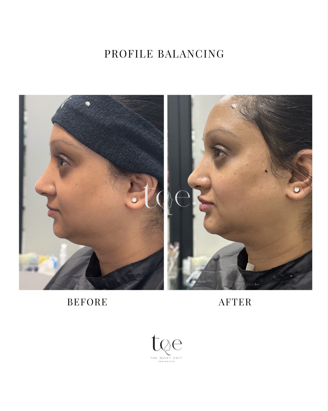 Profile Balancing